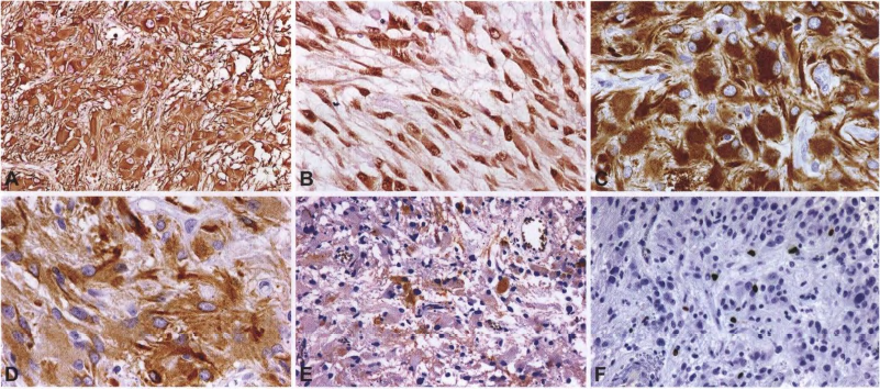 室管膜下巨细胞星形细胞瘤的临床病理学特征_医学界-助力医生临床决策