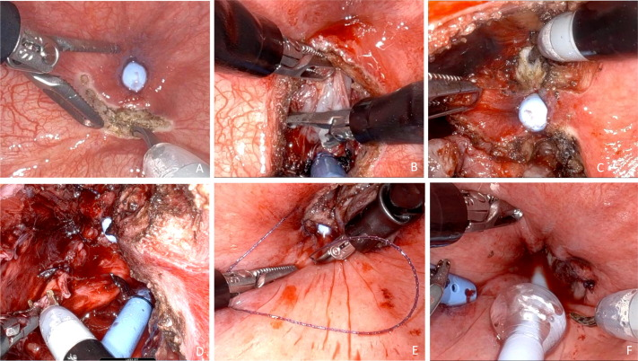 前列腺机器怎么治疗【克利夫兰诊所】机器人单孔经膀胱前列腺部分切除术治疗局限性PCa_https://www.jmylbn.com_新闻资讯_第7张