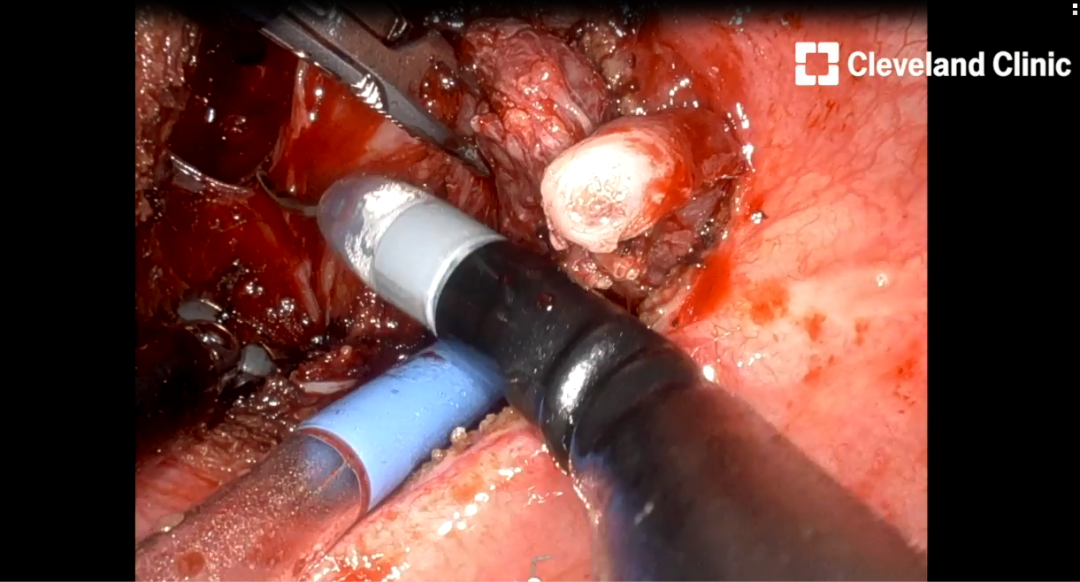 前列腺机器怎么治疗【克利夫兰诊所】机器人单孔经膀胱前列腺部分切除术治疗局限性PCa_https://www.jmylbn.com_新闻资讯_第3张