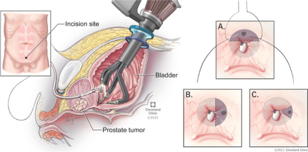 前列腺机器怎么治疗【克利夫兰诊所】机器人单孔经膀胱前列腺部分切除术治疗局限性PCa_https://www.jmylbn.com_新闻资讯_第2张