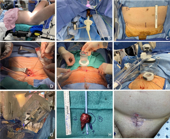 前列腺机器怎么治疗【克利夫兰诊所】机器人单孔经膀胱前列腺部分切除术治疗局限性PCa_https://www.jmylbn.com_新闻资讯_第5张