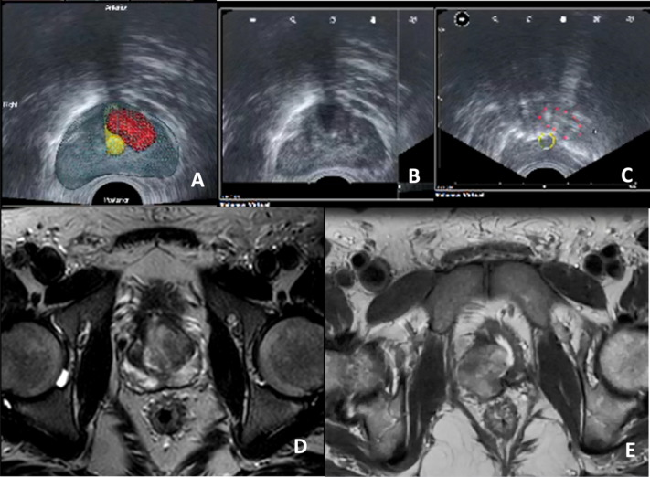 前列腺机器怎么治疗【克利夫兰诊所】机器人单孔经膀胱前列腺部分切除术治疗局限性PCa_https://www.jmylbn.com_新闻资讯_第6张