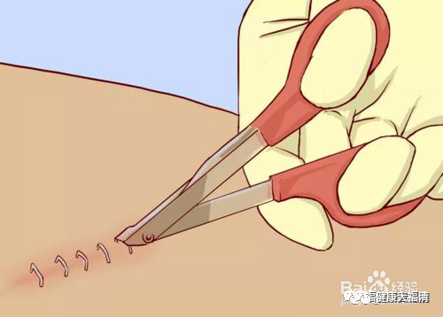 为什么要用皮钉缝合关注｜卫健活动：市三医院：巧用“钉皮机”缝合手术切口_https://www.jmylbn.com_新闻资讯_第11张