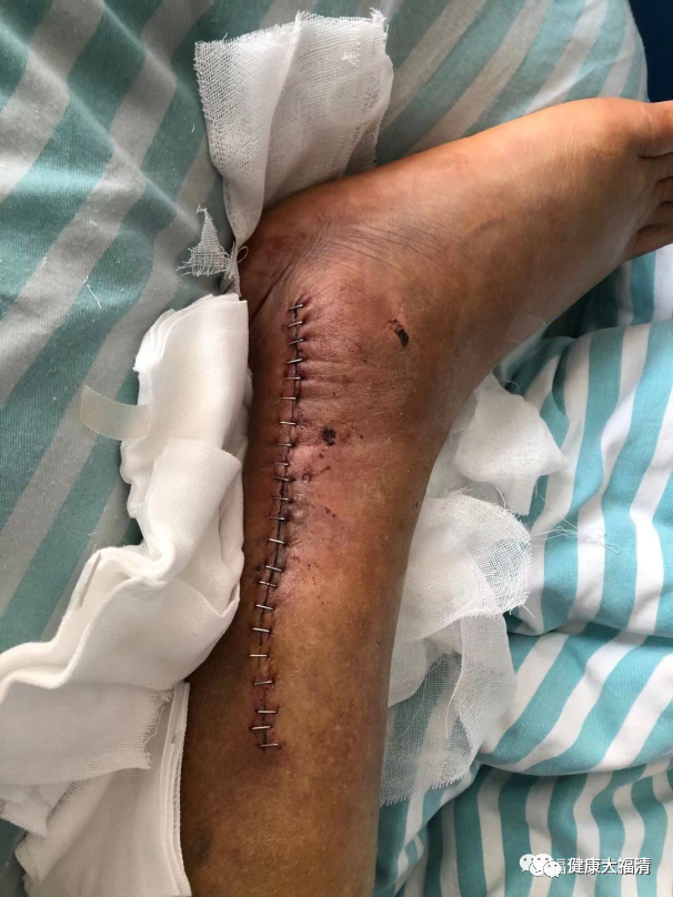为什么要用皮钉缝合关注｜卫健活动：市三医院：巧用“钉皮机”缝合手术切口_https://www.jmylbn.com_新闻资讯_第7张
