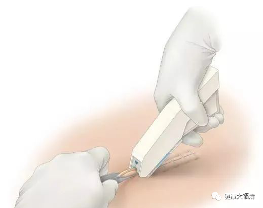 为什么要用皮钉缝合关注｜卫健活动：市三医院：巧用“钉皮机”缝合手术切口_https://www.jmylbn.com_新闻资讯_第2张