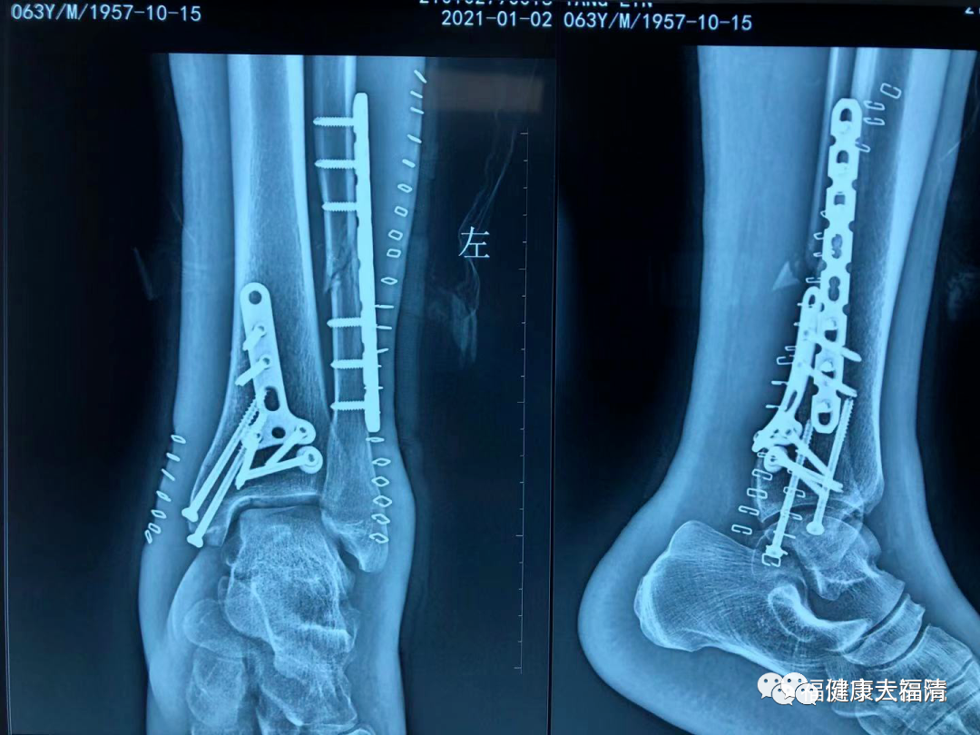 为什么要用皮钉缝合关注｜卫健活动：市三医院：巧用“钉皮机”缝合手术切口_https://www.jmylbn.com_新闻资讯_第8张