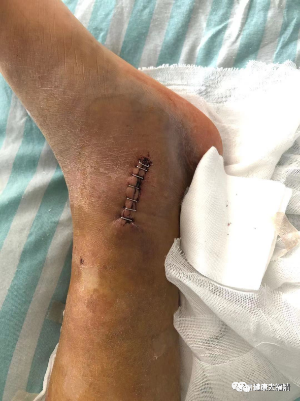 为什么要用皮钉缝合关注｜卫健活动：市三医院：巧用“钉皮机”缝合手术切口_https://www.jmylbn.com_新闻资讯_第6张