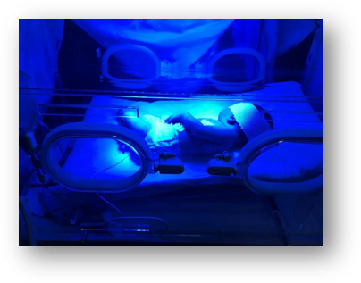 光疗时为什么黑眼罩【特色诊疗】随治随走，“黄疸宝宝”日间光疗来啦_https://www.jmylbn.com_新闻资讯_第5张