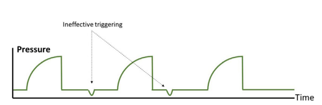 呼吸机模式怎么调节机械通气的基本模式_https://www.jmylbn.com_新闻资讯_第25张