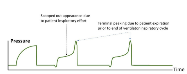 呼吸机模式怎么调节机械通气的基本模式_https://www.jmylbn.com_新闻资讯_第27张