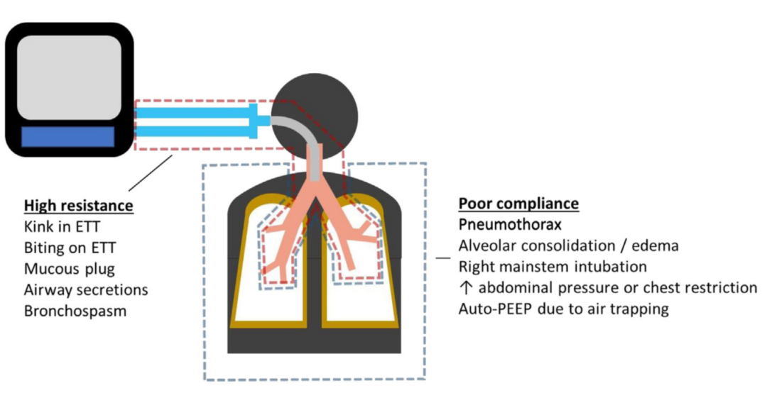 呼吸机模式怎么调节机械通气的基本模式_https://www.jmylbn.com_新闻资讯_第4张