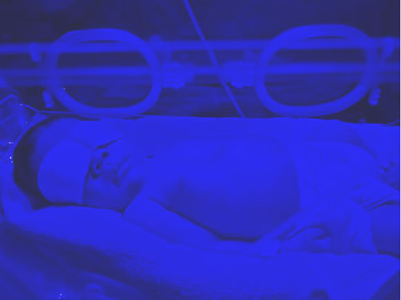 为什么要用光疗纸尿裤【原创科普】新生儿科黄疸日间光疗门诊科普_https://www.jmylbn.com_新闻资讯_第2张