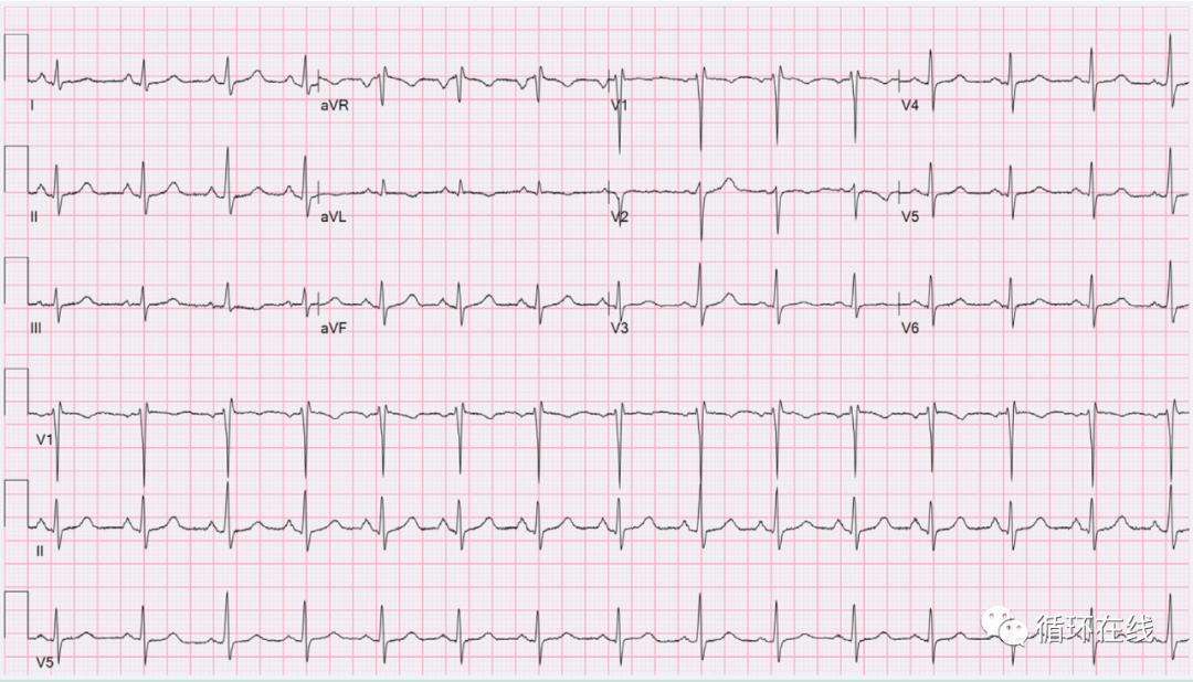 心电病例巨大食管裂孔疝致右位心心电图改变