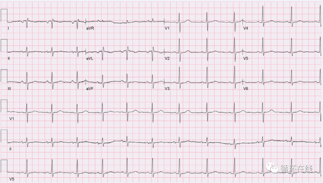 心电病例巨大食管裂孔疝致右位心心电图改变