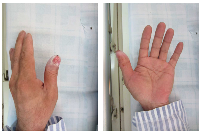 医院过往收治的患者，烧伤面积小未及时就医，氢氟酸不断渗透导致伤口很深