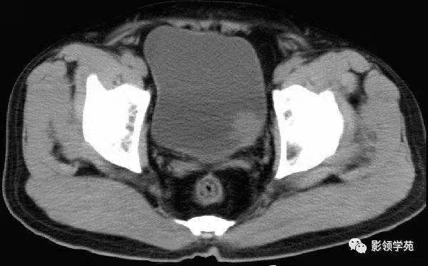 b膀胱镜为什么消毒泌尿外科迈向微创时代新“镜”界——膀胱镜_https://www.jmylbn.com_新闻资讯_第7张