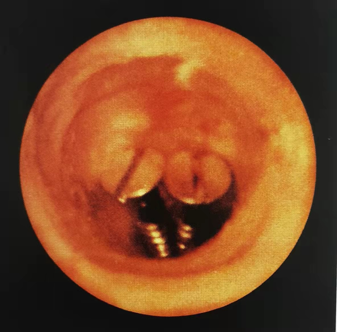 b膀胱镜为什么消毒泌尿外科迈向微创时代新“镜”界——膀胱镜_https://www.jmylbn.com_新闻资讯_第15张