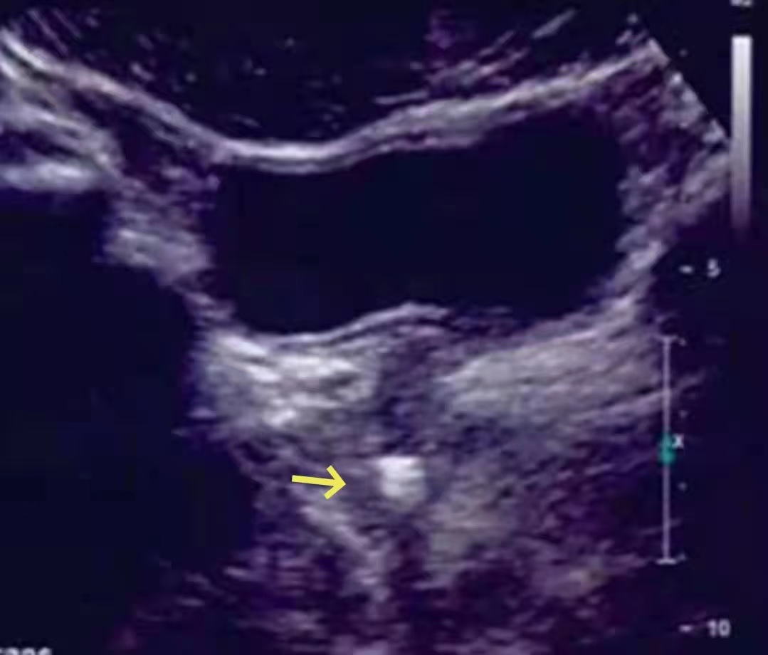 b膀胱镜为什么消毒泌尿外科迈向微创时代新“镜”界——膀胱镜_https://www.jmylbn.com_新闻资讯_第9张