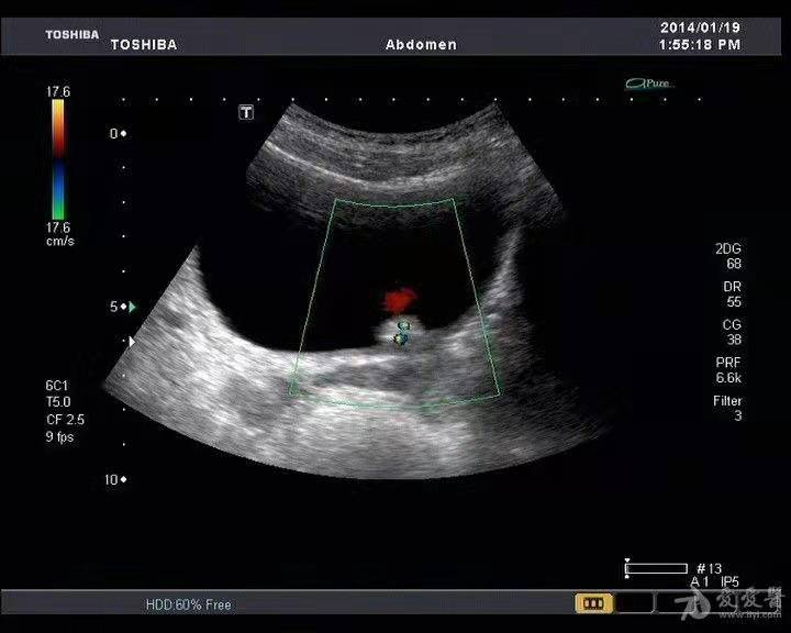b膀胱镜为什么消毒泌尿外科迈向微创时代新“镜”界——膀胱镜_https://www.jmylbn.com_新闻资讯_第6张