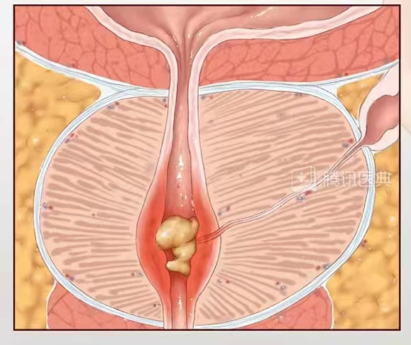 b膀胱镜为什么消毒泌尿外科迈向微创时代新“镜”界——膀胱镜_https://www.jmylbn.com_新闻资讯_第11张