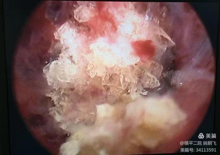 b膀胱镜为什么消毒泌尿外科迈向微创时代新“镜”界——膀胱镜_https://www.jmylbn.com_新闻资讯_第12张