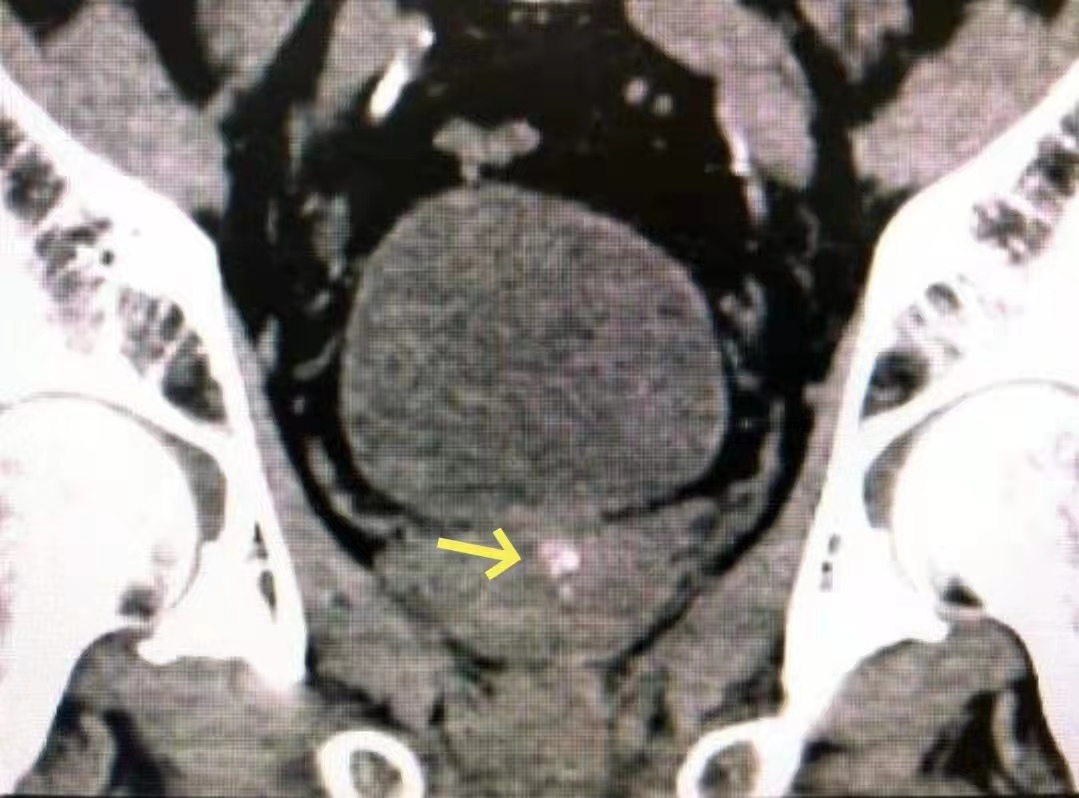 b膀胱镜为什么消毒泌尿外科迈向微创时代新“镜”界——膀胱镜_https://www.jmylbn.com_新闻资讯_第10张