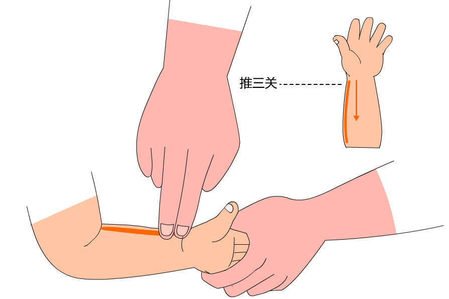 可用拇指面或食,中指面自幼儿的腕关节推向肘关节称为推三关,操作时可