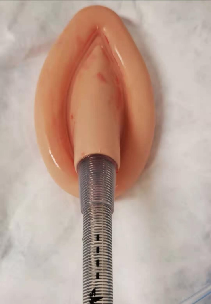 可弯喉罩用于鼻内镜手术的安全性和有效性分析