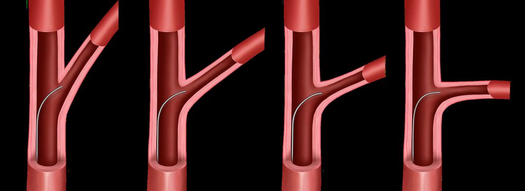 【超详细】介入导丝操作教程，心血管医生基础必备！