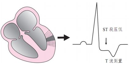 一文詳解：急性心肌梗死的判讀！ 未分類 第24張