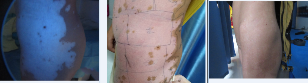 什么是窄谱紫外线治疗【祛白利器】311窄谱UVB紫外线光疗，大面积泛发型白癜风患者的福音_https://www.jmylbn.com_新闻资讯_第10张