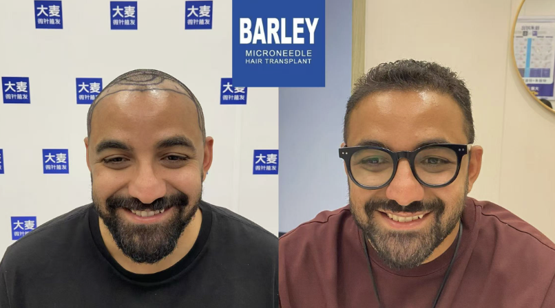 Free Scalp & Hair Consultation for Expats at Barley Hair Transplant