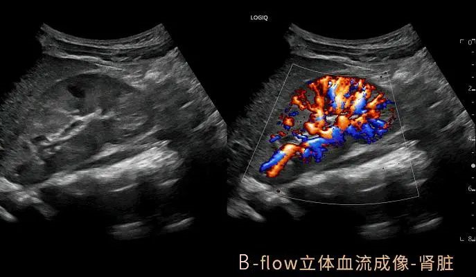 彩超logiq怎么读【重磅消息】更清晰！更高效！更多功能！我院引进GE LOGIQ-Fortis Plus彩超设备_https://www.jmylbn.com_新闻资讯_第5张