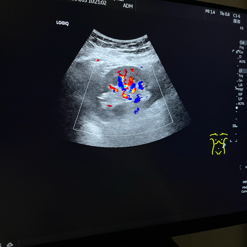 彩超logiq怎么读【重磅消息】更清晰！更高效！更多功能！我院引进GE LOGIQ-Fortis Plus彩超设备_https://www.jmylbn.com_新闻资讯_第11张