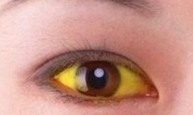 肝病专家讲堂 眼睛发黄一定是肝出了问题 中大肝病百科 微信公众号文章阅读 Wemp