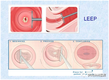 妇科leep刀怎么用LEEP刀科普知识_https://www.jmylbn.com_新闻资讯_第5张