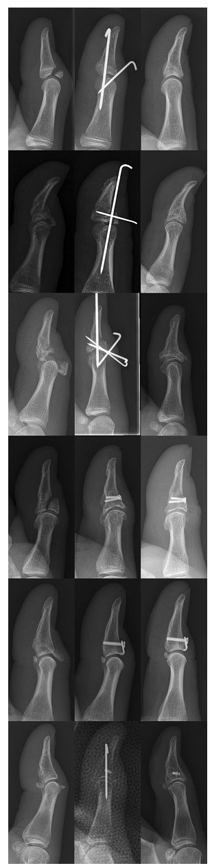 Illustration 2 for 拇指锤状指的特点及治疗 by dr hutaif：全面解析罕见损伤，揭示独特病因、准确诊断与最新高效康复策略