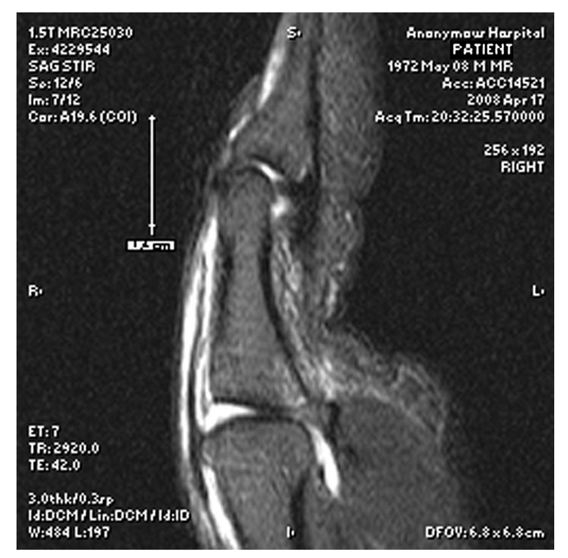 Illustration 1 for 拇指锤状指的特点及治疗 by dr hutaif：全面解析罕见损伤，揭示独特病因、准确诊断与最新高效康复策略