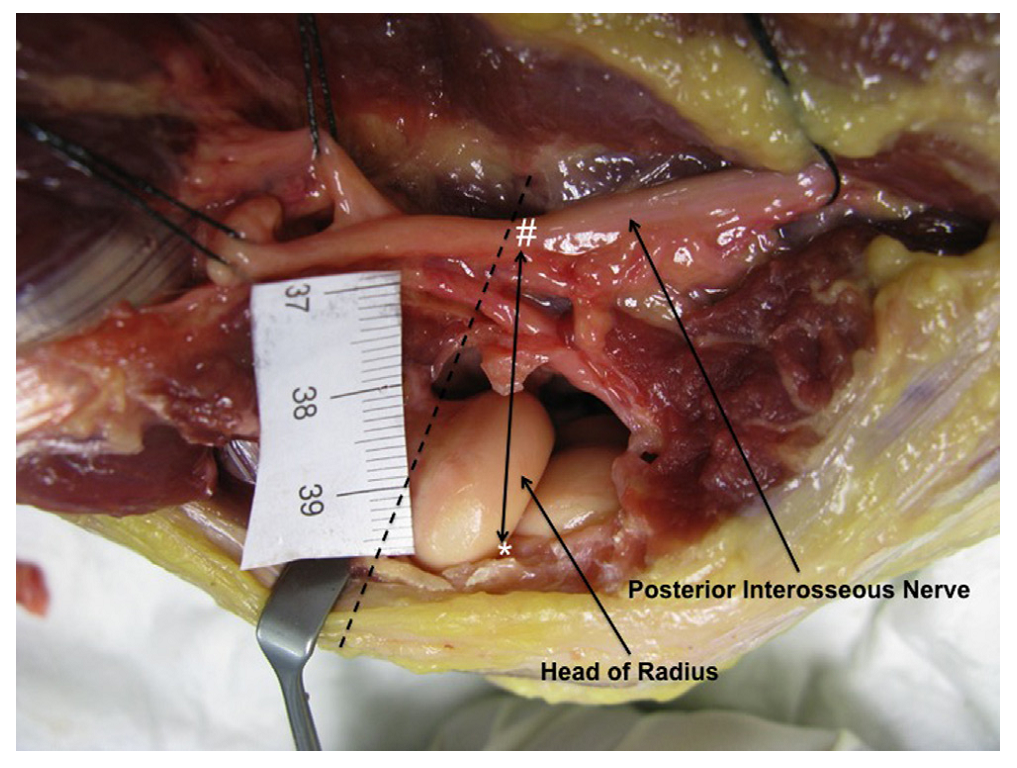 桡骨头外侧显露的三个入路