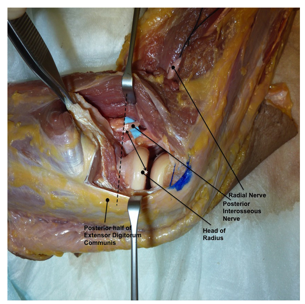 桡骨头外侧显露的三个入路