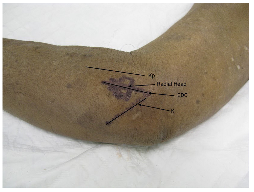 桡骨头外侧显露的三个入路