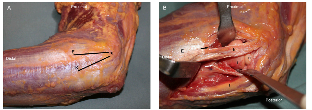 桡骨头外侧显露的三个入路