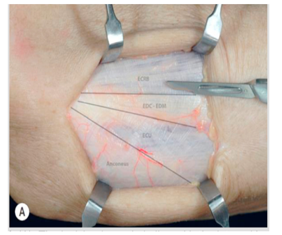 桡骨头外侧显露的三个入路