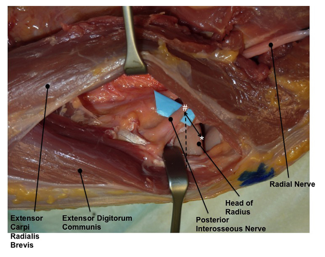 桡骨头外侧显露的三个入路