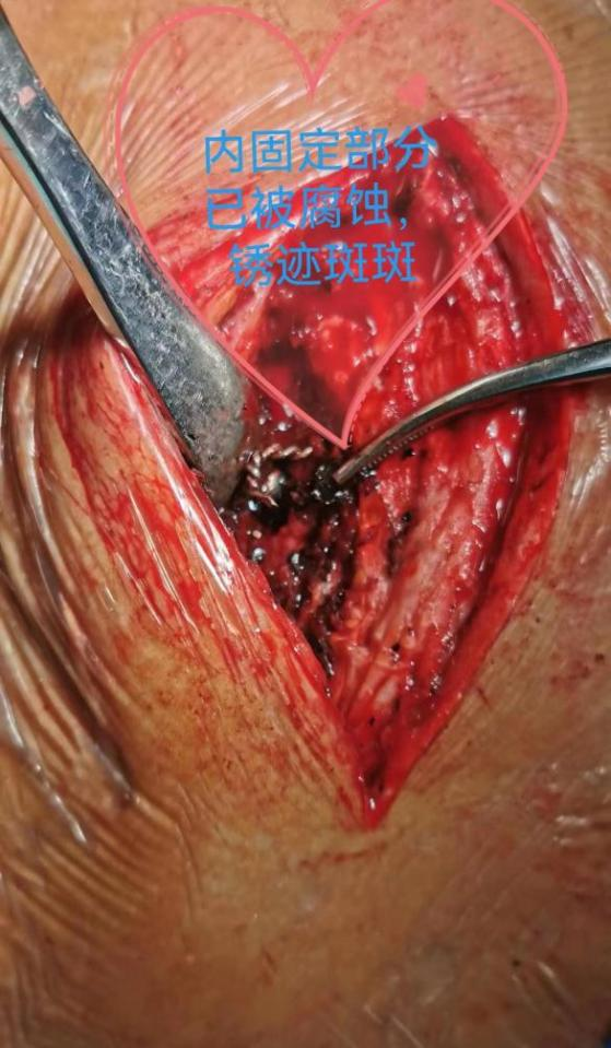 肋骨固定板怎么拆这样的脊柱内固定物，需要手术拆除_https://www.jmylbn.com_新闻资讯_第7张