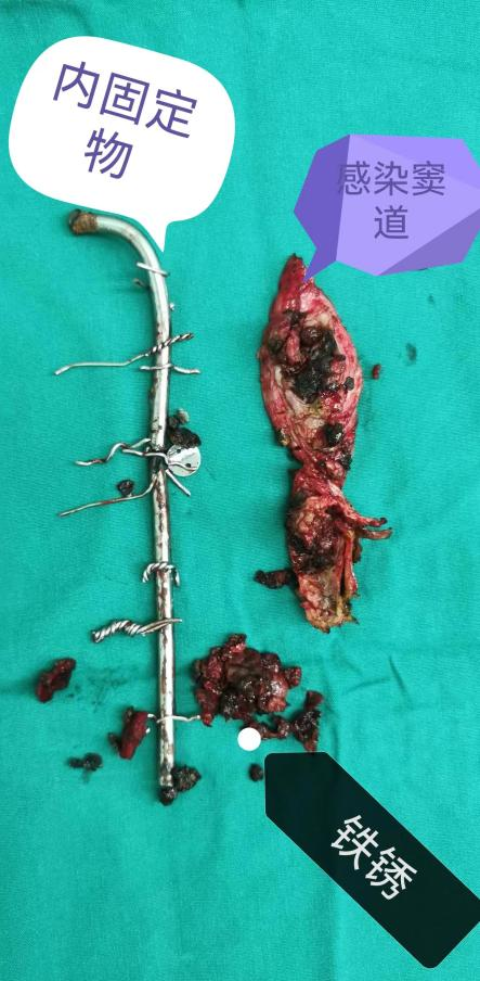 肋骨固定板怎么拆这样的脊柱内固定物，需要手术拆除_https://www.jmylbn.com_新闻资讯_第6张