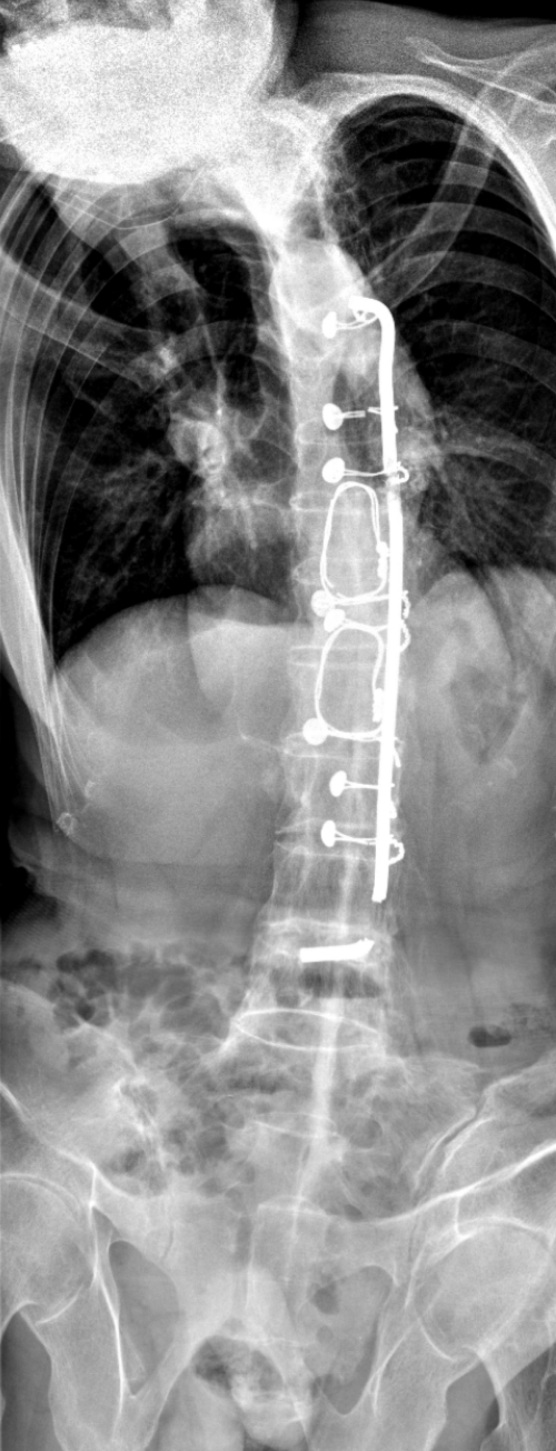 肋骨固定板怎么拆这样的脊柱内固定物，需要手术拆除_https://www.jmylbn.com_新闻资讯_第4张