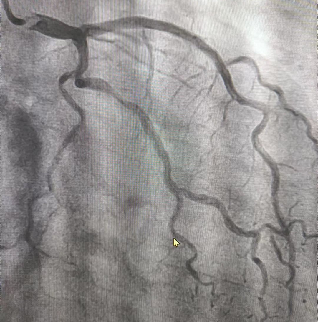 医术前沿丨望奎县中医院介入科成功完成经桡动脉心脑血管联合造影同时