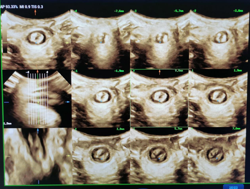 什么是超声容积探头妇科超声 ｜ 盆底超声检查技巧及标准化测量_https://www.jmylbn.com_新闻资讯_第5张