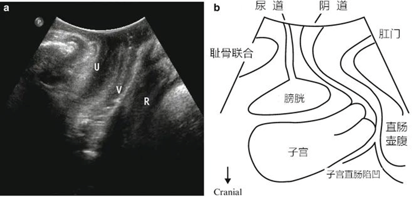 什么是超声容积探头妇科超声 ｜ 盆底超声检查技巧及标准化测量_https://www.jmylbn.com_新闻资讯_第3张